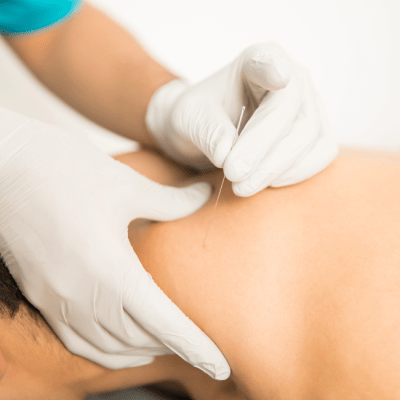 DRY NEEDLING